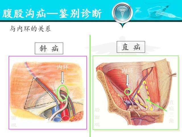 iii:斜疝,内环口大于二指(>4cm),腹横筋膜和腹股沟管后壁不完整或