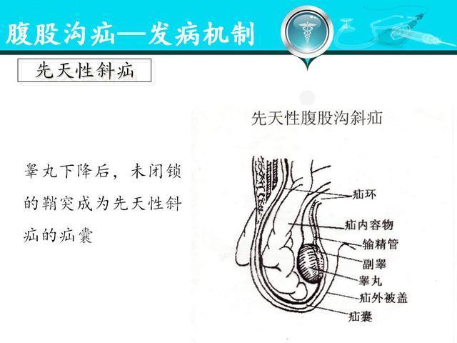 人体腹股沟疝的分型诊疗