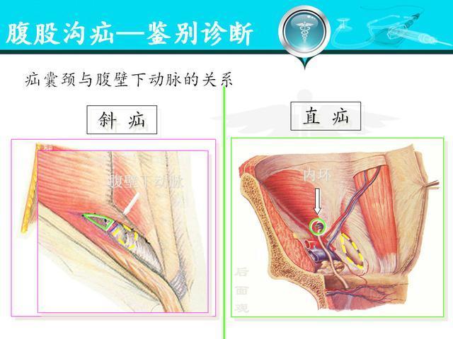 人体腹股沟疝的分型诊疗