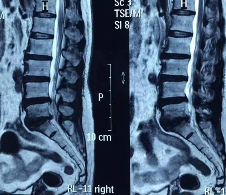 病例分析 这例腰椎退变终板炎,你诊断对了吗?