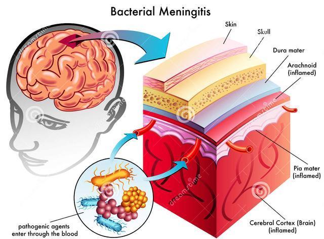 脑膜炎是什么