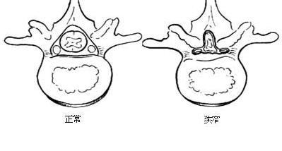 按解剖部位分可分为中央型狭窄,侧隐窝狭窄,神经根孔狭窄.