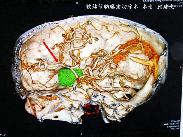 鞍结节脑膜瘤切除术简介