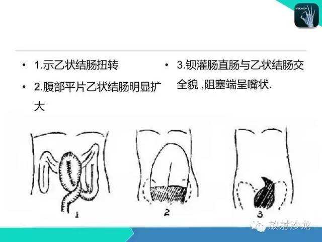 肠梗阻的分类及影像诊断