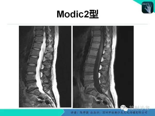 椎体终板骨软骨炎的影像学表现