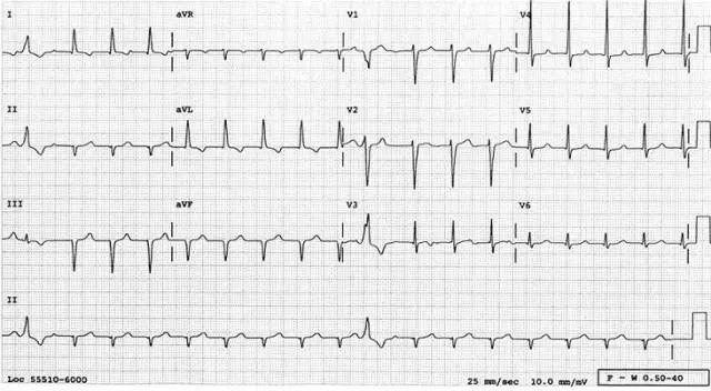 心电图诊断,万不可操之过急!