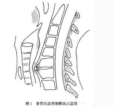 颈椎椎体前鸟嘴样增生压迫食管引起吞咽困难(经食管钡剂检查证实)等.