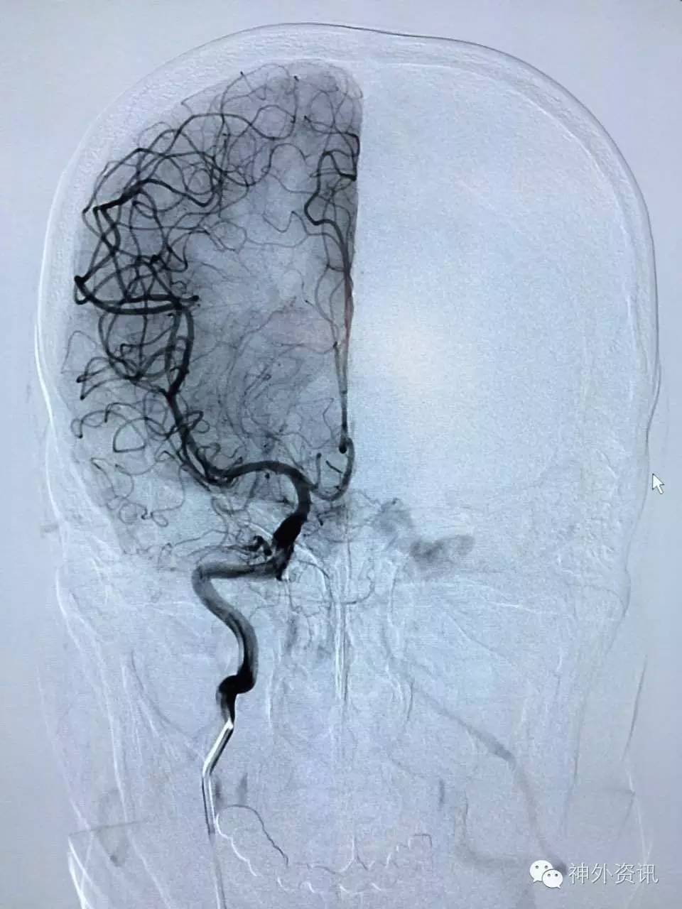 天新福神经介入专栏邓剑平教授海绵窦区动静脉瘘栓塞术1例