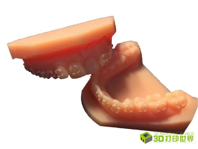 3D打印定制隐形牙箍,法国Dentosmile怎么做?