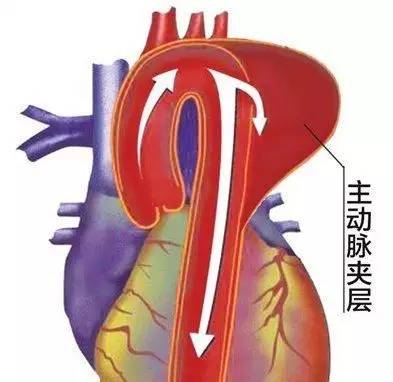 的定时炸弹心血管外科成功完成两例高难度全胸腹主动脉夹层动脉瘤手术