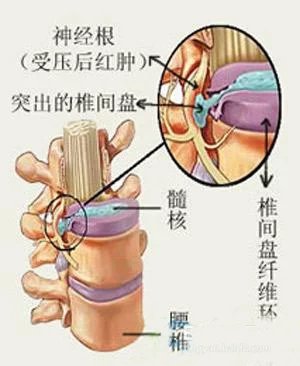 1, 神经根型颈椎病