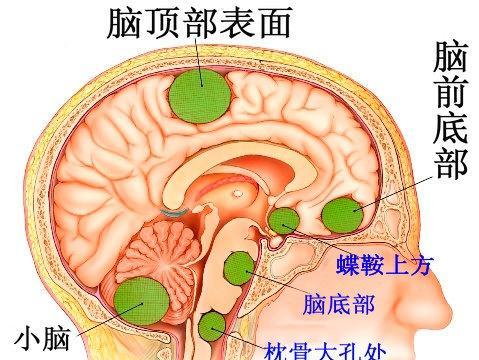 神经外科后颅窝手术的术中护理配合