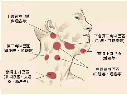 淋巴瘤gdp_淋巴瘤早期症状图图片(2)