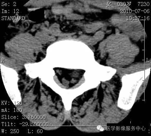 腰椎间盘CT,不能只看椎间盘!