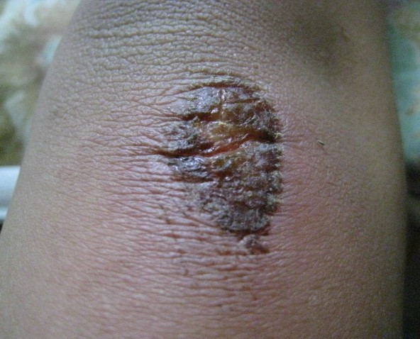 伤口感染化脓炎症艾灸后明显改善