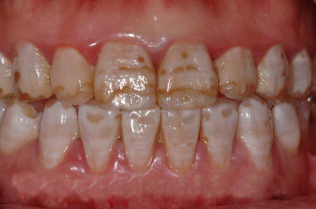 牙齿为什么越来越黄?