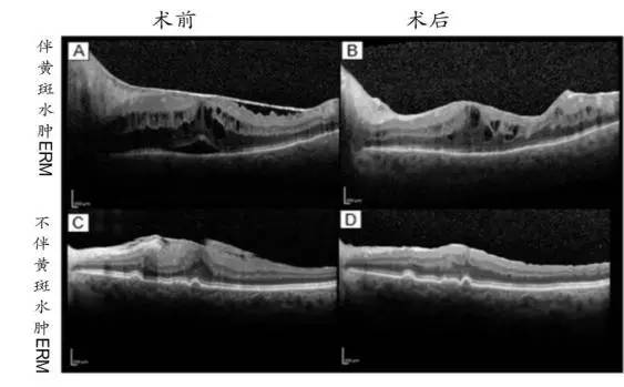 图2.伴/不伴黄斑水肿的erm玻切手术前后