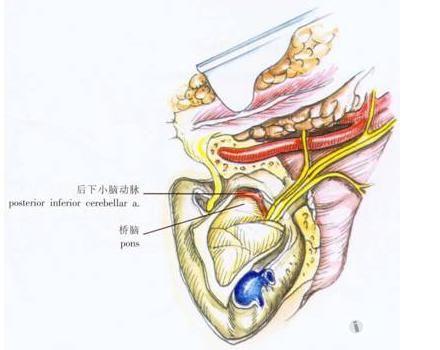 多发群体 41～70岁女性 常见发病部位 颅底颈静脉孔,中耳鼓室 常见