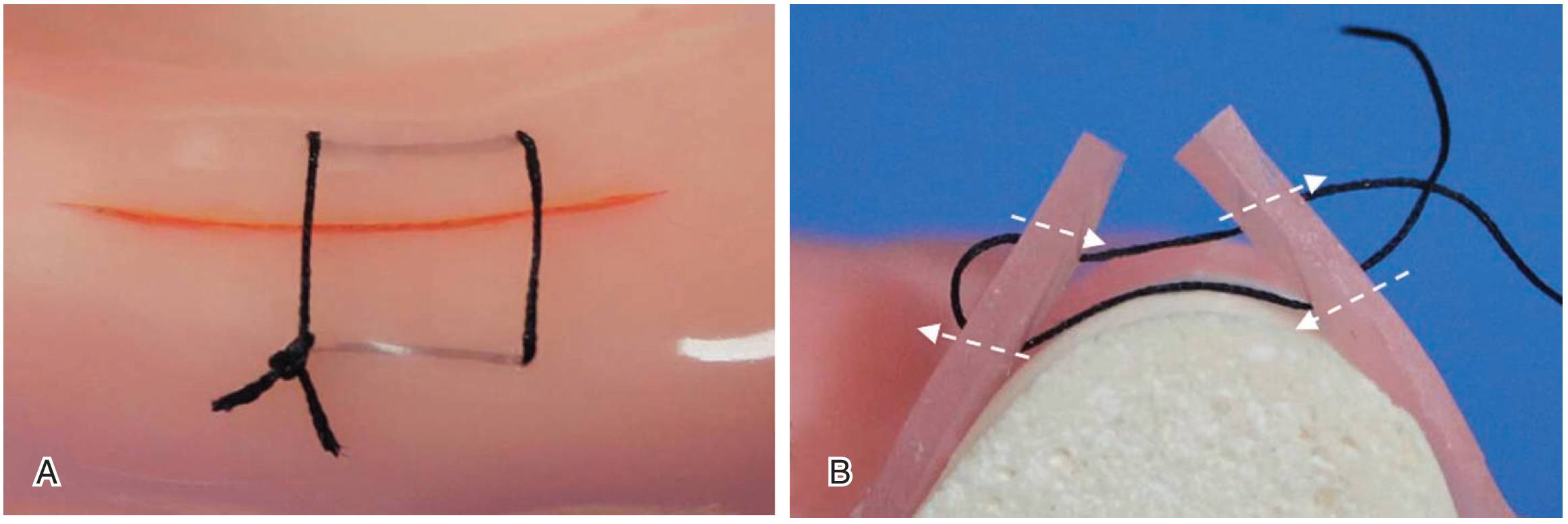 Ob/Gyn Updated : Sutures are better than staples in third or high-order ...