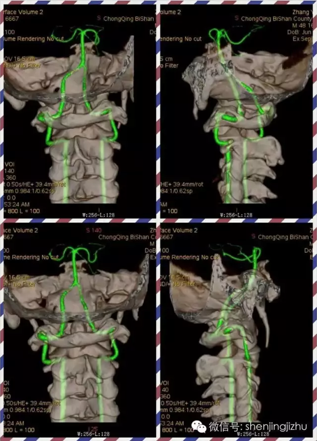 病例分享:枢椎齿状突ii型骨折