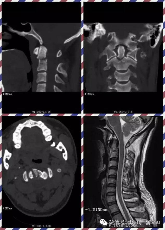 病例分享:枢椎齿状突ii型骨折
