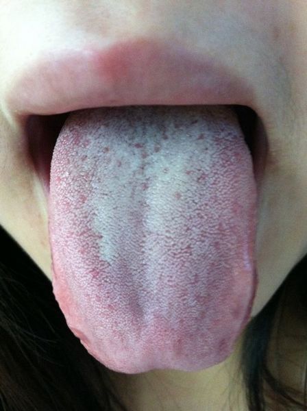 舌苔发白、大便粘连、肥胖,痰湿严重,试试食疗