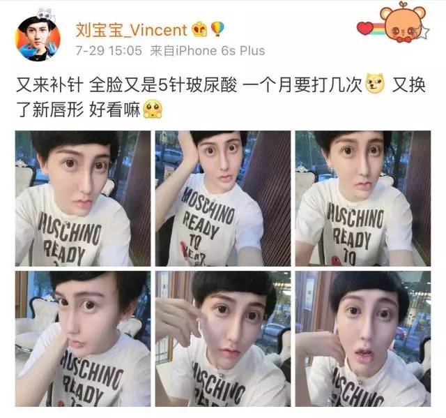 蛇精男刘梓晨满脸玻尿酸照片太辣眼睛你还敢点进来吗