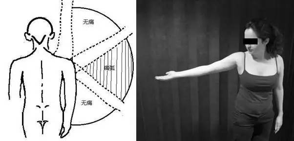 图 11 疼痛弧征检查示意图 上文结合组成肩袖的四条肌肉的解剖及功能