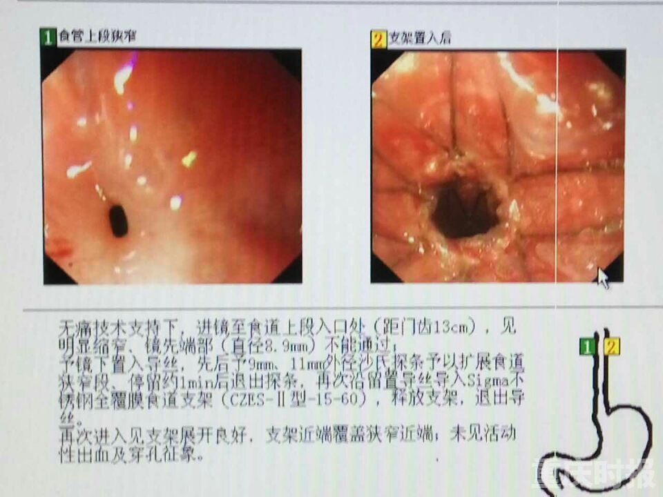 5毫米,正常人的食道管约有2厘米,还不到正常人的1/10,在进行了 次食管