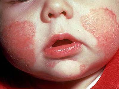 8个月婴儿湿疹怎么办?有什么好的办法治疗