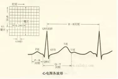 无p波或p波在Ⅰ,Ⅱ,avf倒置,为异位心律.