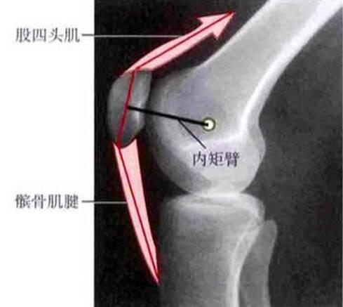 髌骨脱位的那点“家常”事