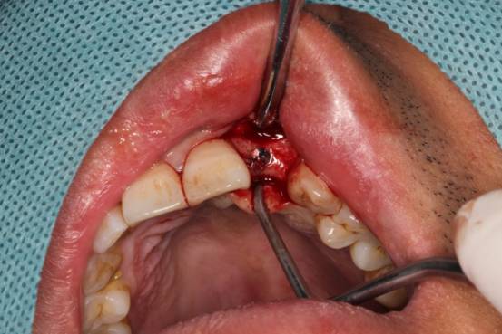 中心医院口腔种植牙权威专家揭秘种植牙全过程