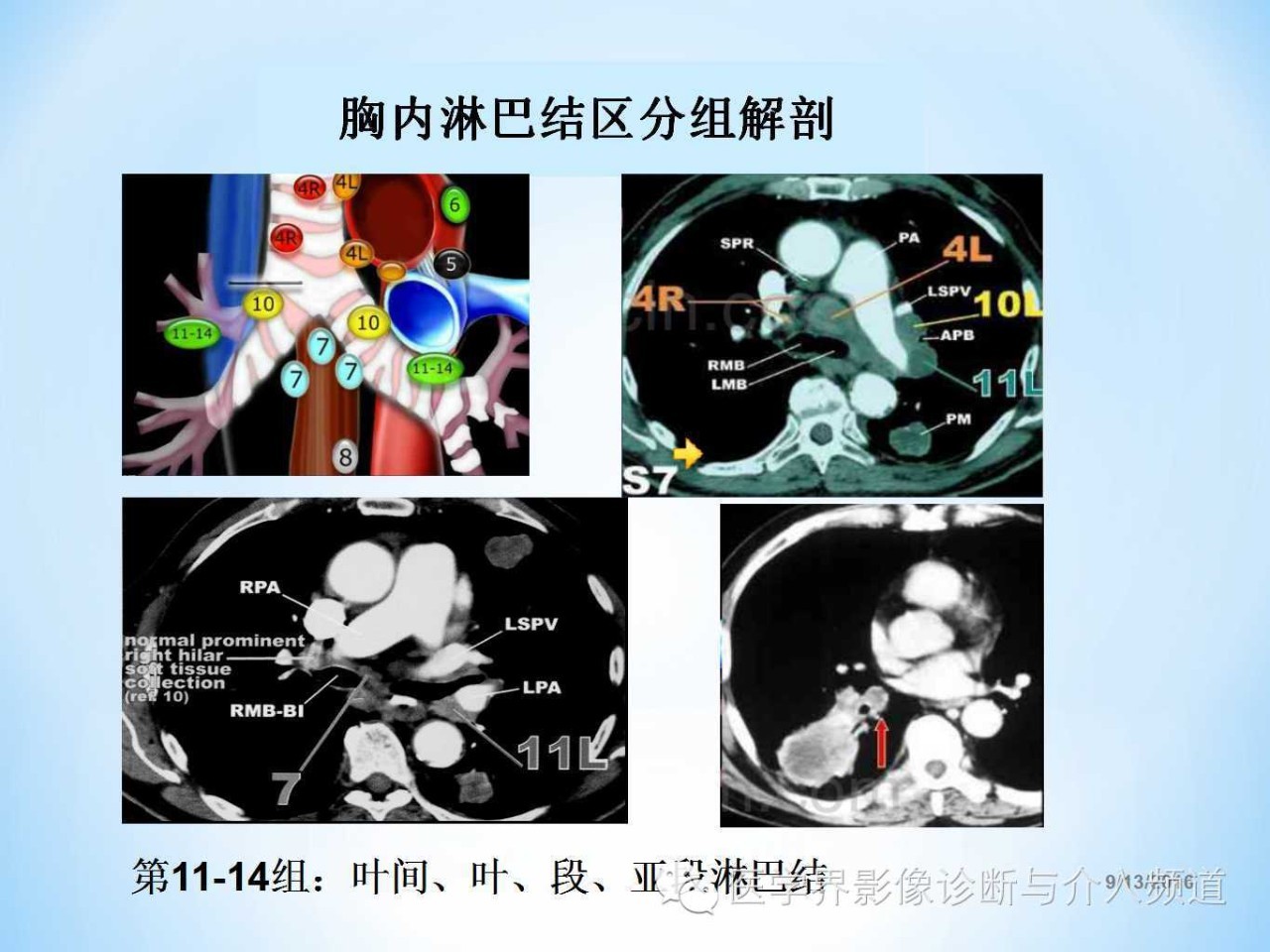 肺部及胸内淋巴结分组解剖超全