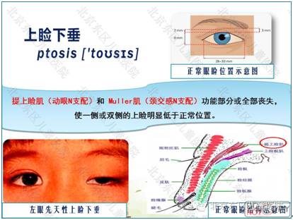 定义:上睑下垂是指眼睑的提上睑肌或muller肌功能部分或全部丧失,使