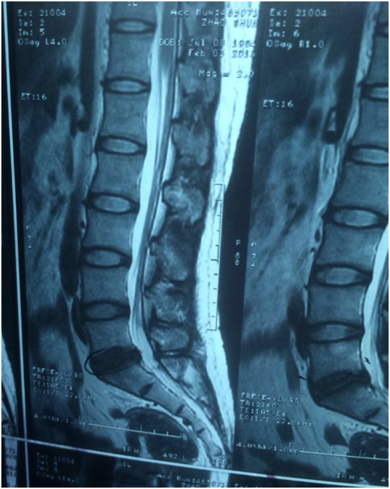 【微·义诊】病例:轻度腰椎间盘能手术吗?