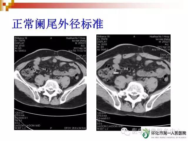 急性阑尾炎的ct诊断简单易懂