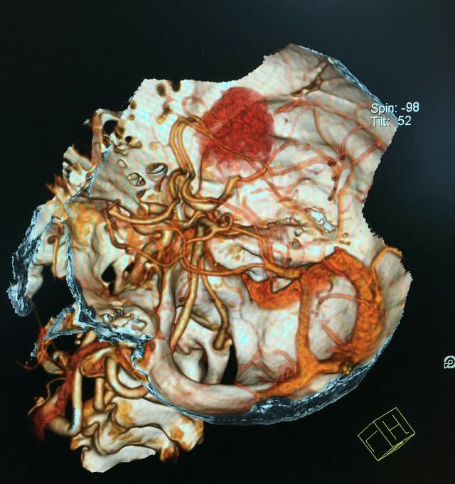 三维CT血管造影在颅底肿瘤手术中的应用