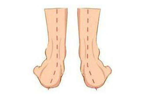 莆田回春堂：类风湿关节炎致使的十种四肢举动部畸形
