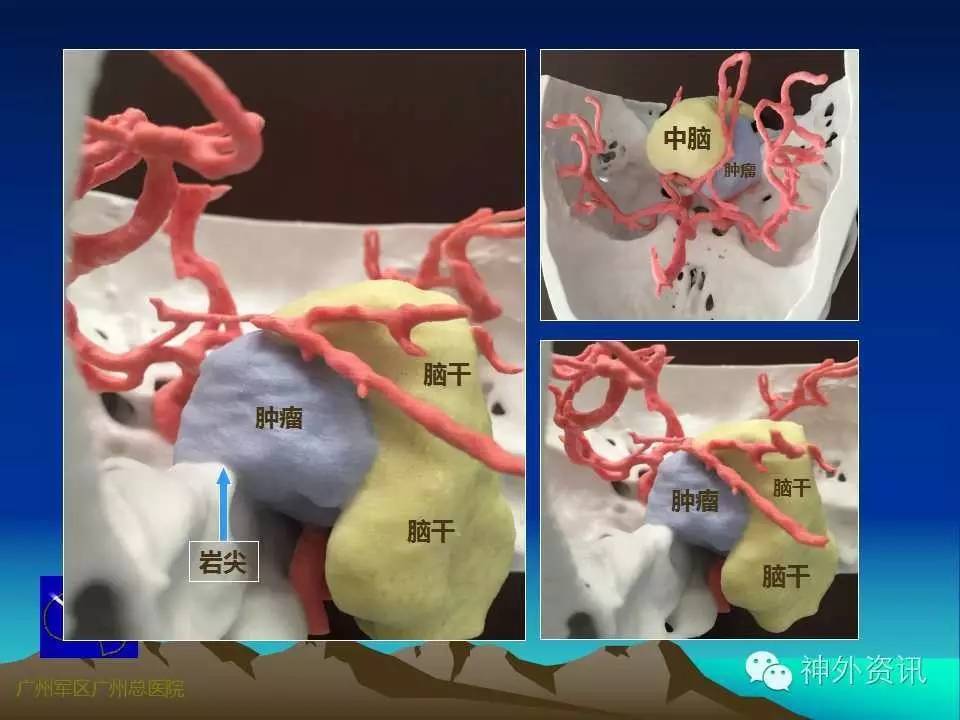 王国良教授:岩尖区肿瘤的显微手术策略