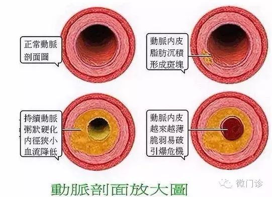 高血脂能不能够逆转？十道有用药膳，能保持喝就行