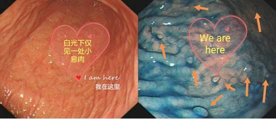精细胃镜检查(二)——色素内镜(上)