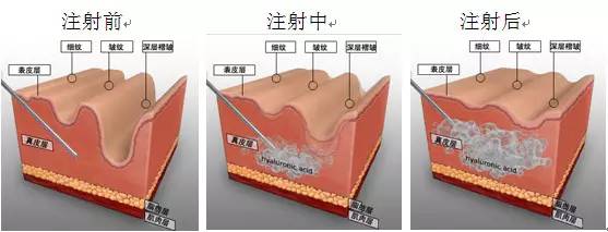 小魅带你图游,了解一下自体脂肪填充 美颜效果 什么是玻尿酸 玻尿酸