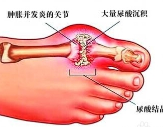 蜂窝织炎常伴随全身症状,血尿酸不升高.2.