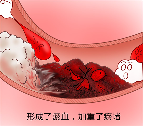 大漫中医-上篇讲瘀血,现讲瘀血形成实原因,如何破