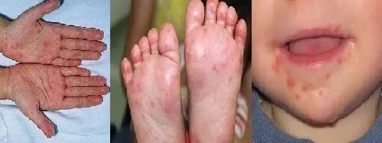 手足口病(hand foot and mouth disease)是一种儿童传染病,多发生于