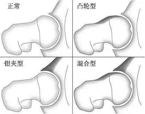 混合型(mixed type)钳夹型(pincer type):常见于髋臼内陷,髋臼后倾等