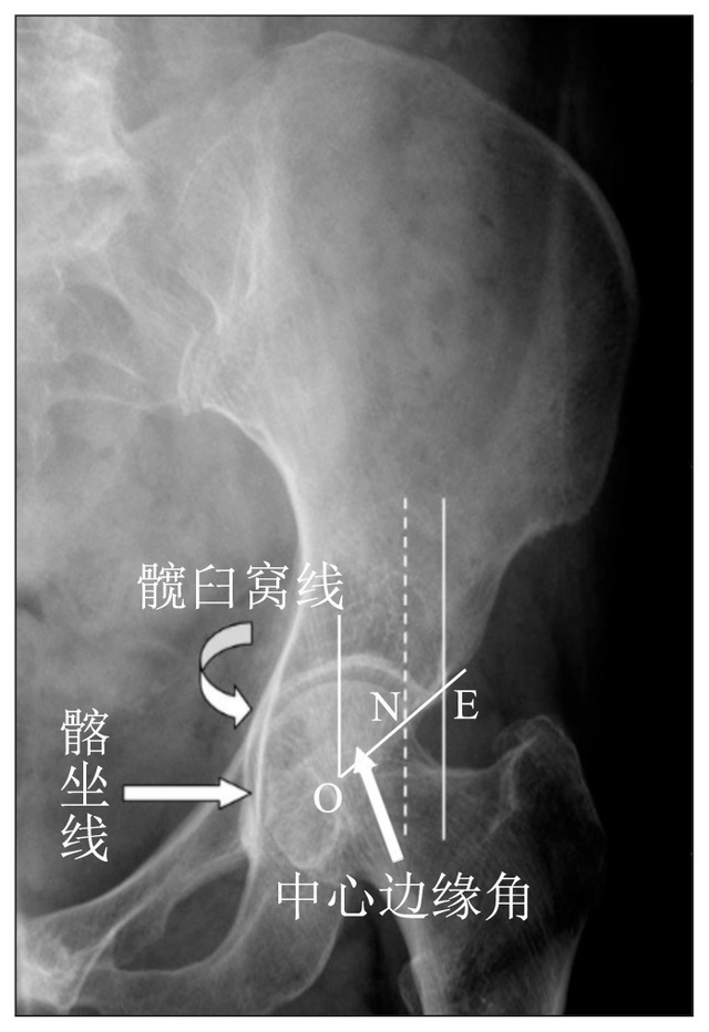 (1)中心边缘角为股骨头中心 o 与髋臼最外侧缘 e 连线 oe 与垂直线的