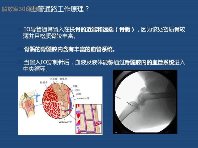 新型急救方法-骨髓腔急救输液系统