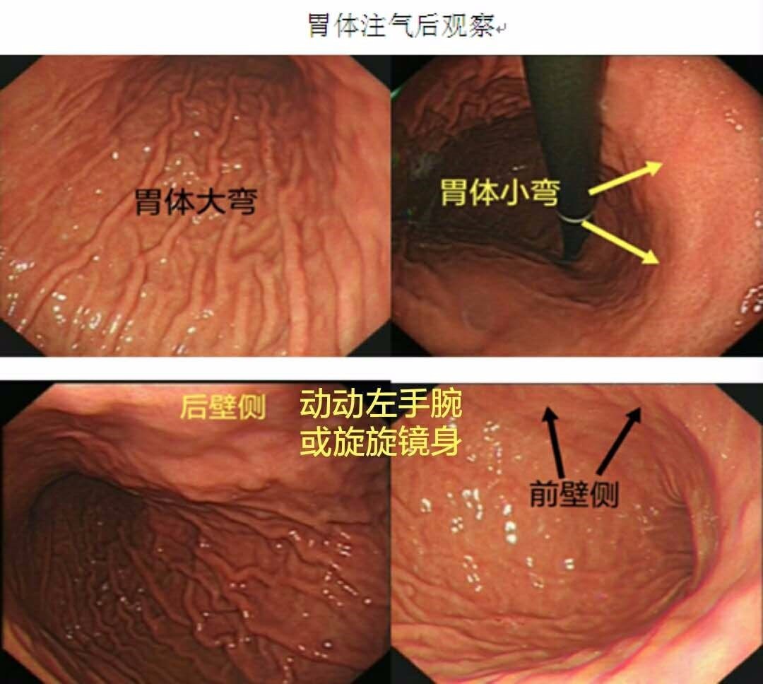 看内镜"老司机"如何一镜到底!